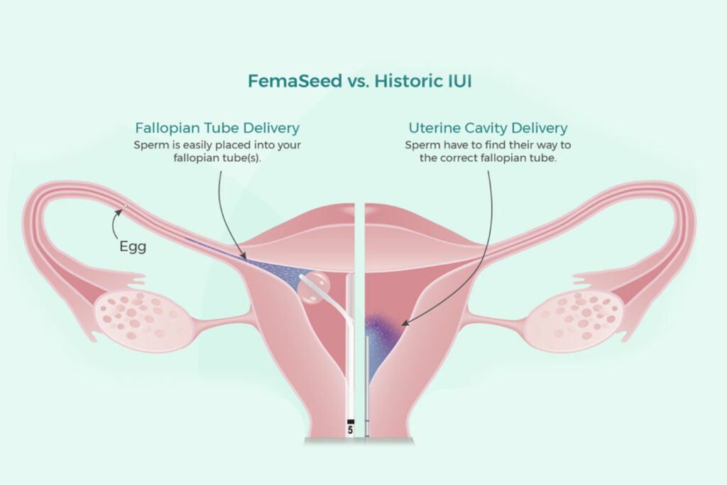 Intratubal Insemination (ITI)