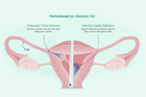 Intratubal Insemination (ITI)