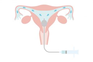 Hysterosalpingogram (HSG)
