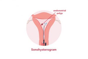 Sonohysterogram